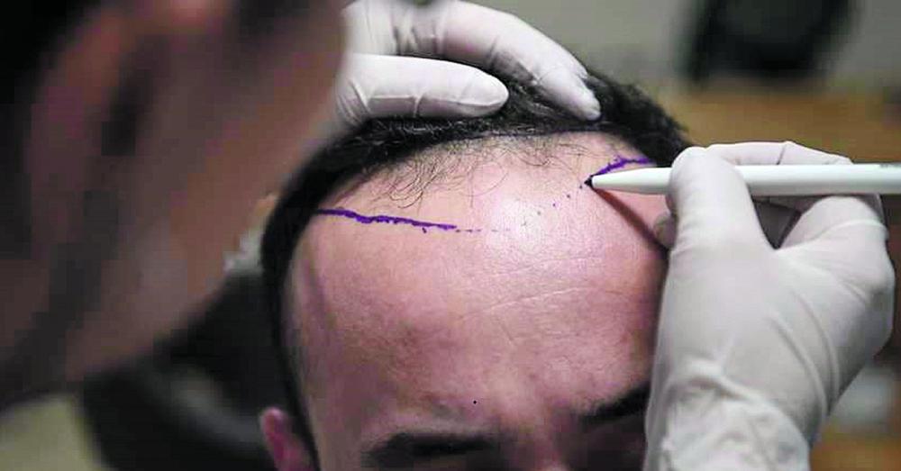 نمو الشعر بات ممكنًا في 6 أيام