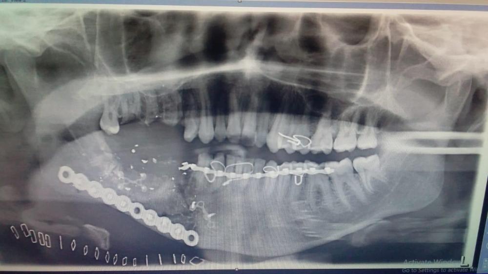 «جراحو صامطة» ينقذون شابا أصيب بطلقة في الوجه