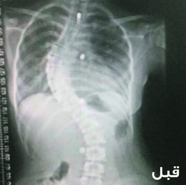 بعد 6 سنوات.. إنهاء معاناة فتاة مع عمودها الفقري