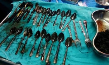 بالصور.. استخراج «ملاعق وشوك» من أمعاء مريض مصري