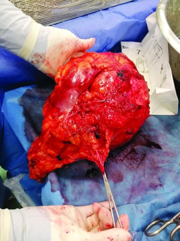 8 ساعات لاستئصال ورم متمدد لستيني بمكة