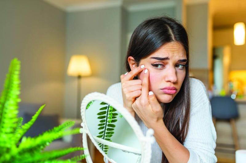 جل الصبار.. علاج طبيعي لحب الشباب