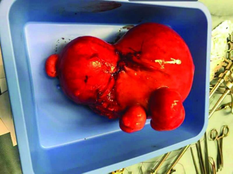 بأورام ليفية.. نجاح استئصال رحم «خمسينية» بجدة