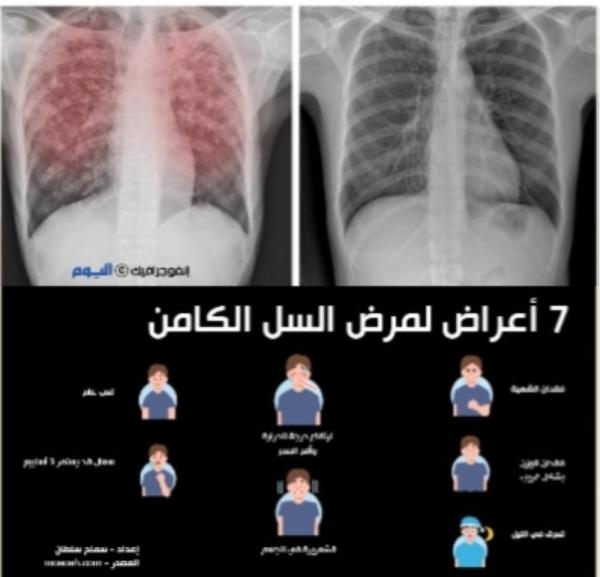 7 أعراض لمرض السل الكامن