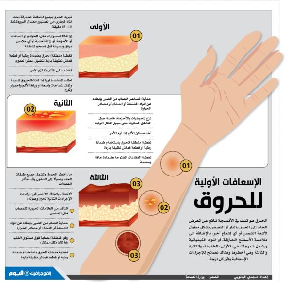 الإسعافات الأولية للحروق