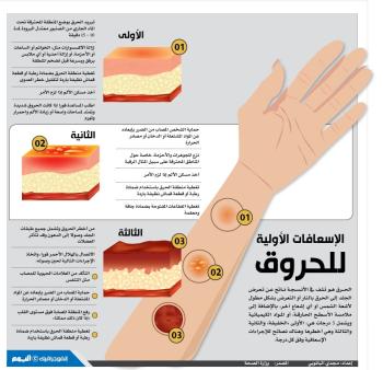 الإسعافات الأولية للحروق