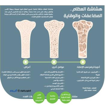 هشاشة العظام .. المضاعفات والوقاية