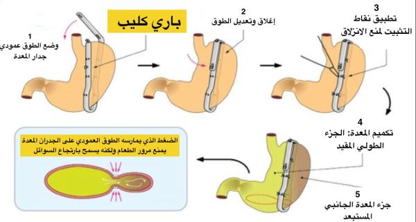 السمنة.. نمط حياة يقود للموت البطيء