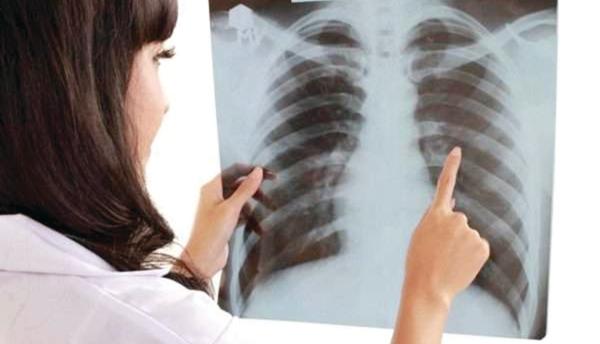 علاج جديد لـ«نجمة الموت»
