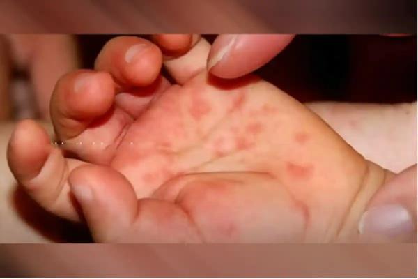 إنفلونزا الطماطم.. أعراض مزعجة لكنها ليست خطيرة