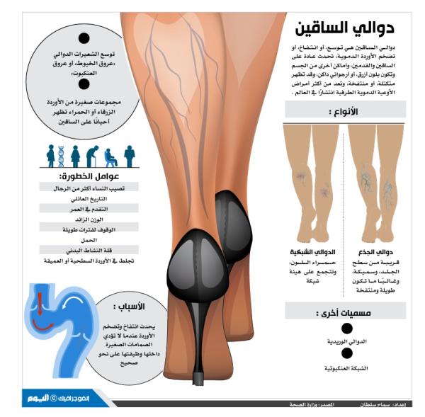 دوالي الساقين