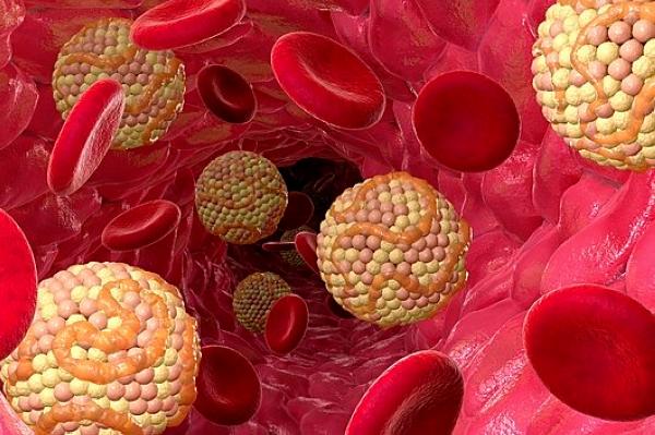 High cholesterol levels. Computer artwork balls of cholesterol in a blood vessel. Cholesterol is a lipid, a fat-like substance. High blood levels of LDL (low-density lipoprotein) cholesterol compared to HDL (high-density lipoprotein) cholesterol are thought to raise the risk of atherosclerosis, the build-up of fatty deposits on artery walls. This is a major cause of heart attack and stroke.