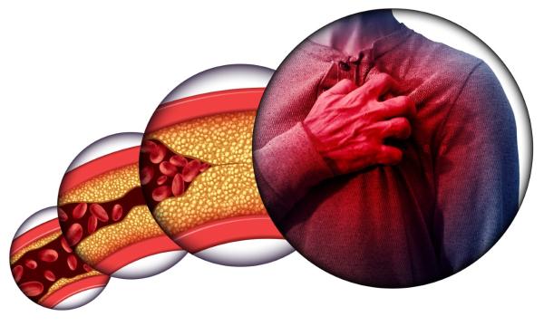 نمط الحياة الصحي يقلل تراكم الكوليسترول الضار