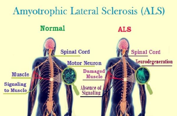 التصلب الجانبي الضموري - scientificworldinfo