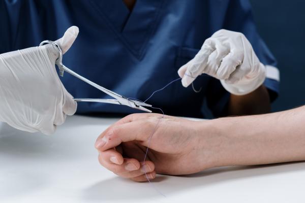 بالخطوات.. كيف تعتني بالغرز الجراحية لتجنب العدوى؟