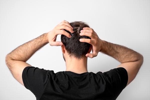 تتمتع صودا الخبز بفعالية كبيرة في علاج الحكة المرافقة لظهور قشرة الرأس- مشاع إبداعي