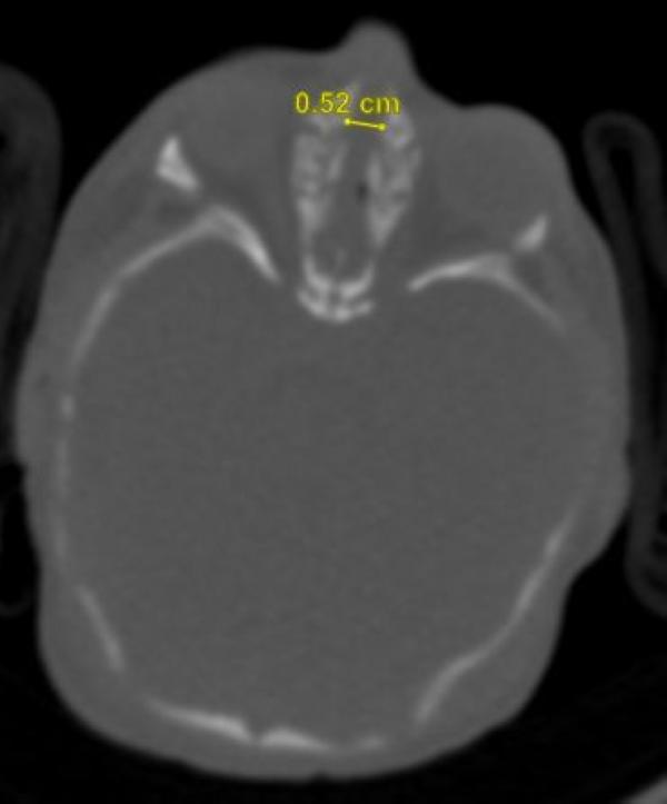 وبعد عمل الفحوصات والأشعة اللازمة شُخّصت حالة الطفلة بما يعرف بـ Congenital nasal pyriform aperture stenosis - اليوم
