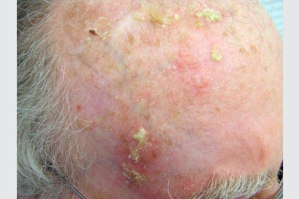 هناك طرق مختلفة لعلاج التقرن الشمسي، مثل استخدام كريم أو جيل يصفه الطبيب المختص - مشاع إبداعي