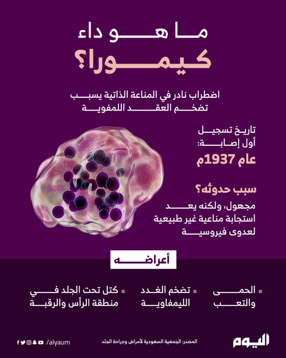 اضطراب نادر.. ما هو داء كيمورا وأعراضه؟
