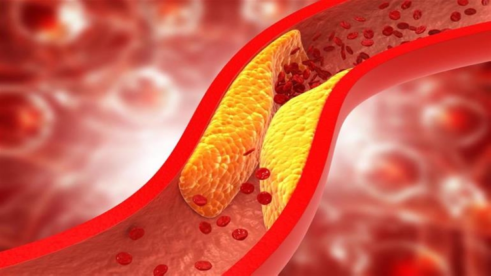 التخثّر الوريدي أثناء السفر يمكن أن يسبب جلطات دموية - مشاع إبداعي