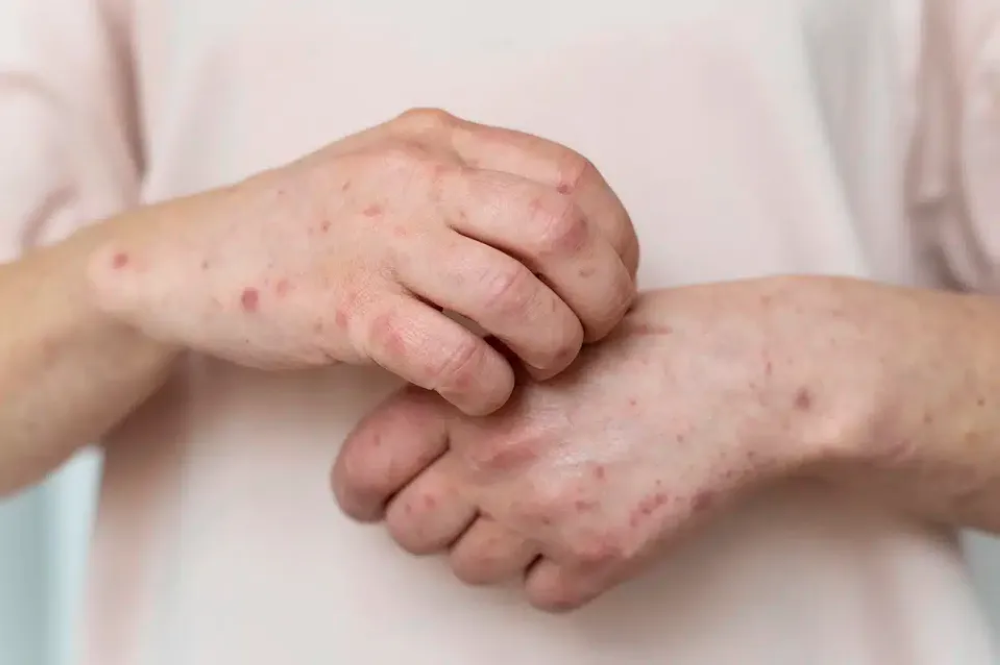 مختصون لـ ”اليوم“: الذئبة الحمراء ”مرض الألف وجه“ والتشخيص المبكر يحمي الأعضاء الحيوية 