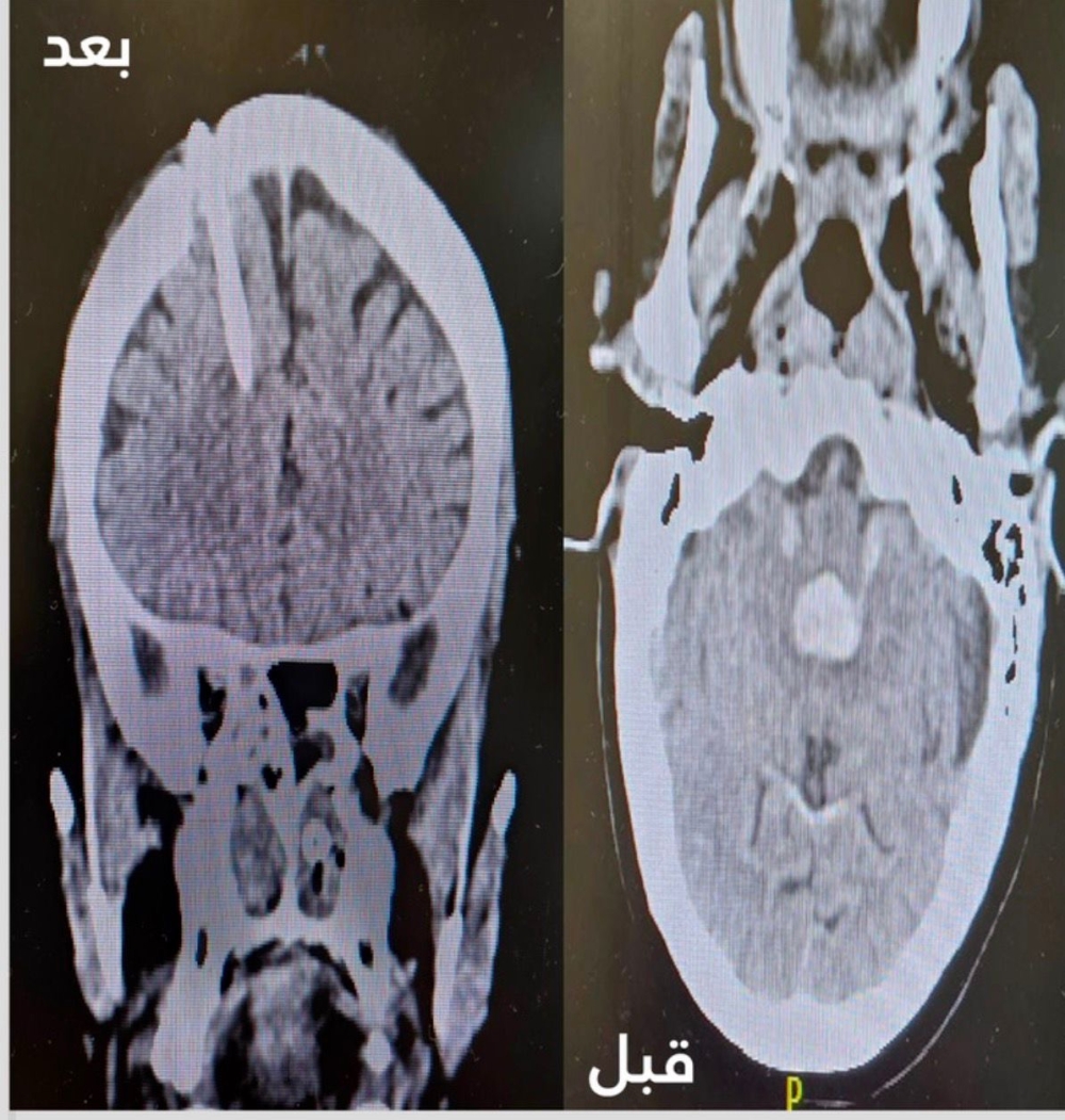 تدخل جراحي دقيق ينهي معاناة خمسينية من نزيف دماغي بمستشفى الأمير عبدالمحسن
