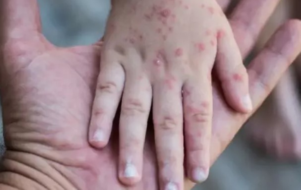 أسوأ تفشٍ منذ 35 عاما.. مستوى غير مسبوق لإصابات الحصبة في أمريكا أسوأ تفشٍ منذ 35 عاما.. مستوى غير مسبوق لإصابات الحصبة في أمريكا