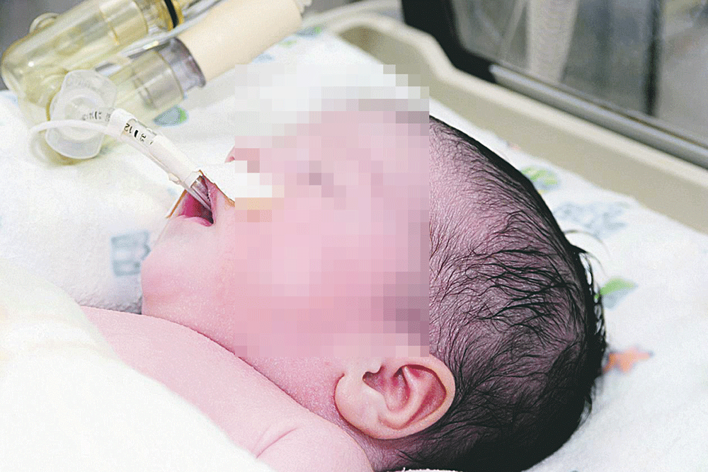 طفل خديج في الحاضنة (اليوم)